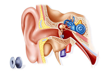 Exostosis Surfer’s Ear