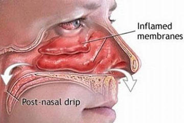 Allergy Hay Fever